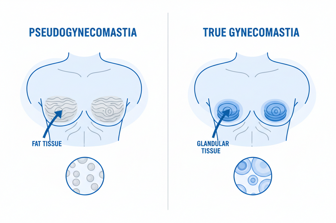 Pseudogynecomastia vs. True Gynecomastia