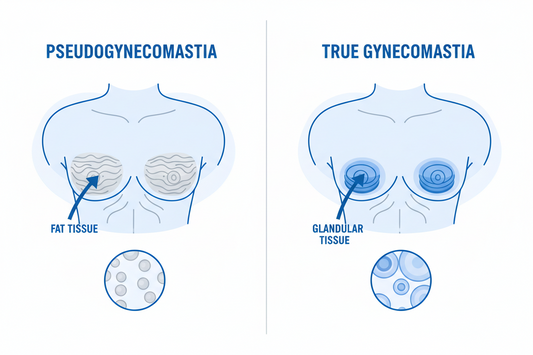 Pseudogynecomastia vs. True Gynecomastia